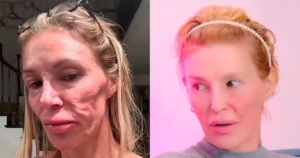 Estrela de reality que teve o rosto ‘derretido’ por parasita é hospitalizada após fazer tratamento que aprendeu no TikTok