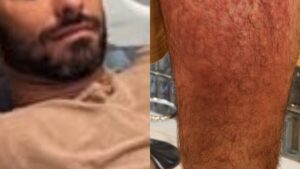 Ex-ator da Globo assusta ao revelar que foi hospitalizado em viagem: ‘Fui devorado’