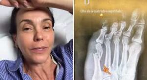 Flavia Monteiro quebra pé após acidente com cachorro e passa por cirurgia de emergência