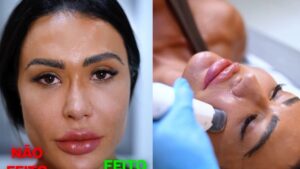 Gracyanne Barbosa e Mais Celebridades Reversão Procedimentos Estéticos: Veja Quem Mudou de Ideia