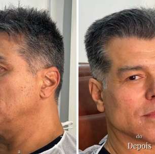 Maurício Mattar Superou Medo e Se Rendeu à Harmonização Facial: ‘Boneco? Não!’
