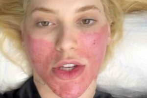 Virginia Fonseca surge com rosto vermelho e explica o mistério