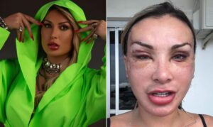 Andressa Urach se recupera da 50ª cirurgia e vai precisar tirar novos documentos