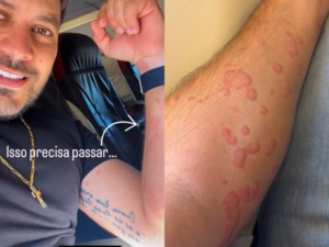 Ex-BBB Caio Afiune é hospitalizado após crise alérgica assustadora