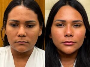 Chaiany Andrade surpreende com transformação após harmonização facial