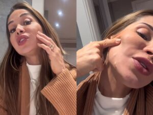 Alerta sobre PMMA: Especialista Comenta Relato de Maíra Cardi