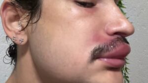 Ken de CG: Influenciador internado após espremer espinha na boca assusta seguidores