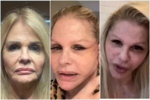 Monique Evans mostra resultado incrível 7 dias após cirurgia plástica