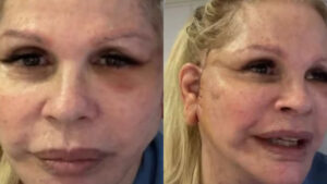 Monique Evans Rebate Críticas Sobre Procedimento aos 70 Anos