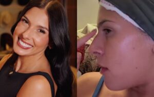 Ana Castela descarta silicone e revela plano para cirurgia no nariz: confira o motivo