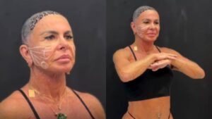 Gretchen Realiza Tratamentos de Rejuvenescimento e Transplante Capilar