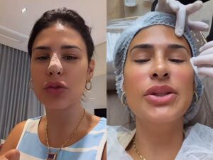 Simone Mendes aparece com curativo no rosto e revela procedimento estético surpreendente!