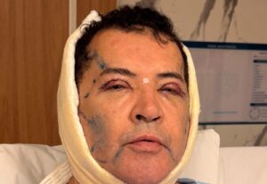 Beto Barbosa coloca silicone no rosto e mostra recuperação após cirurgia plástica