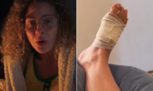 Debby Lagranha passa por cirurgia após ser picada por aranha-marrom e desabafa: ‘Chorei de dor’