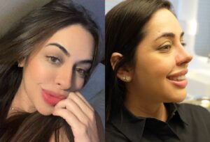 Flávia Morais, namorada do sertanejo Giovani, faz rinoplastia e cirurgia no queixo