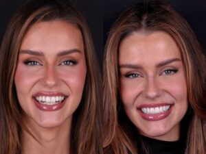 Marcella Kozinski, Miss Brasil Universo 2026, estreia sorriso novo na briga pelo título mundial