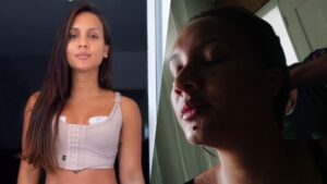 Ex-BBB Maxiane passa por mastopexia e revela imprevisto na recuperação